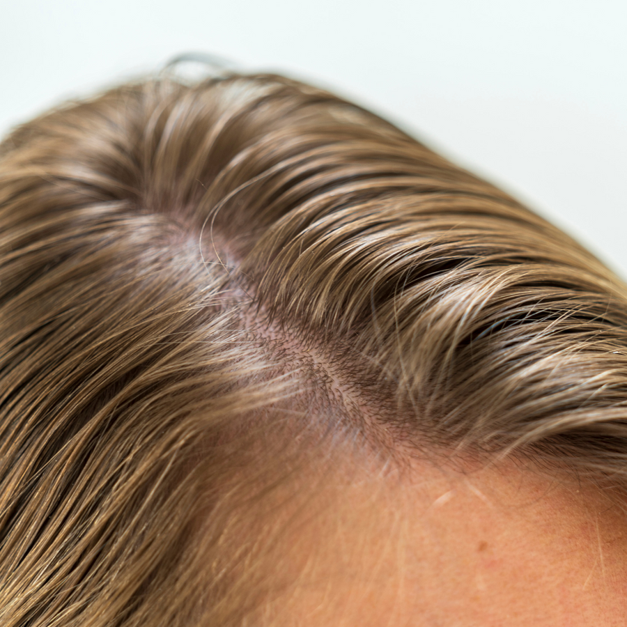 cheveux gras en été 