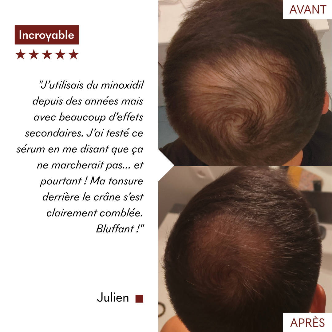 Mallette Post-Greffe capillaire/PRP